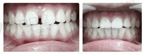 牙科富士2的用途（富士II补牙）(图1)